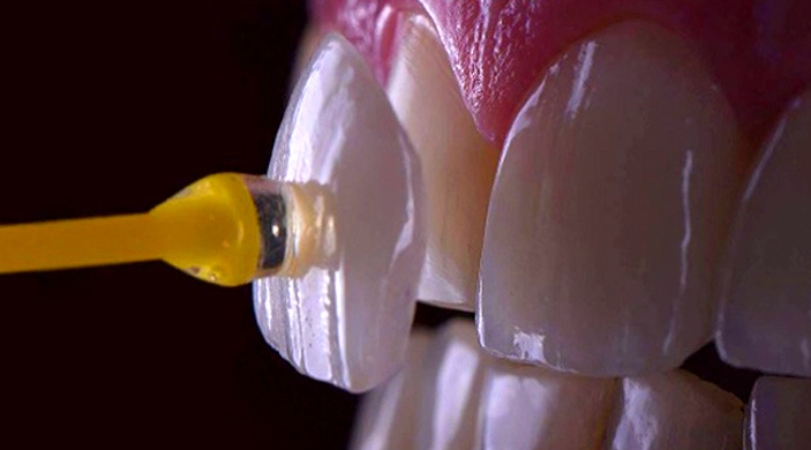 Laminates & Veneers in Chinchwad – Perfect Smile Makeovers