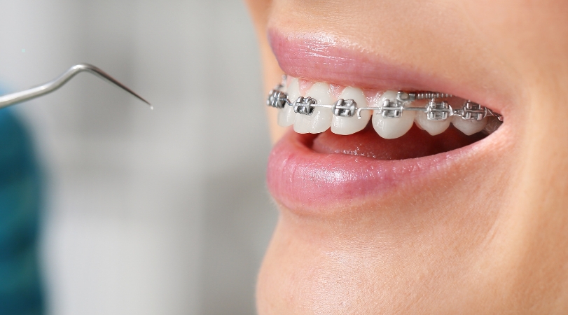 Orthodontics & Braces in Chinchwad – Perfectly Aligned Smiles