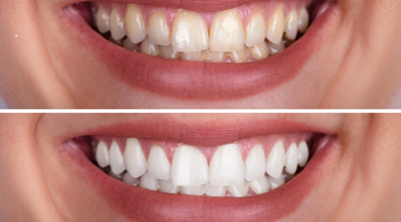 Teeth Whitening in Moshi – Brighter Smile in One Visit